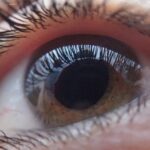 Glaucoma